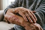 Herpes zóster (culebrilla): qué es y síntomas