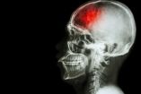 Infarto cerebral: los síntomas que debes reconocer y por qué tienes 4.5 horas para actuar