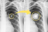 Los nódulos pulmonares podrían ser indicador de cáncer