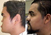 Ángel Abraham recuperó la respiración, masticación y su calidad de vida mediante una reconstrucción facial integral realizada por especialistas del Seguro Social en Nuevo León.