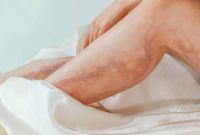 ¿La trombosis es una de las principales causas de complicaciones vasculares prevenibles?