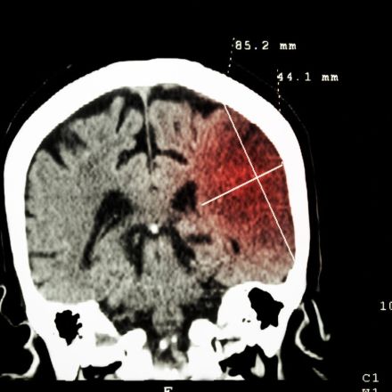 Infarto cerebral: los síntomas que debes reconocer y por qué tienes 4.5 horas para actuar