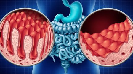 ¿Cuáles son las 5 enfermedades del sistema digestivo?