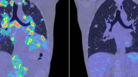 Tipos de cáncer menos mortales cuáles tienen mayor supervivencia y por qué
