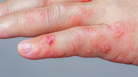 Herpes zóster (culebrilla): qué es y síntomas