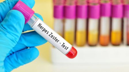 Herpes zóster (culebrilla): qué es y síntomas