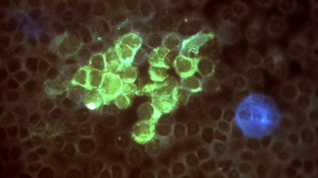 Herpes zóster (culebrilla): qué es y síntomas