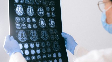 ¿A qué edad comienza la enfermedad de Alzheimer?