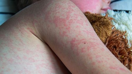 Sarampión en México: cómo saber si necesitas vacunarte o ponerte refuerzo