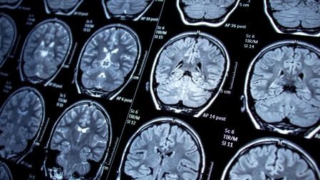 Qué es la epilepsia