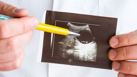 ¿Qué pasa cuando una mujer tiene quistes en los ovarios?