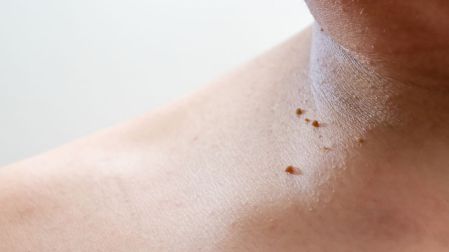 Por qué salen manchas oscuras en el cuello y cómo quitarlas viernes
