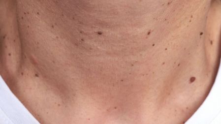 Por qué salen manchas oscuras en el cuello y cómo quitarlas viernes