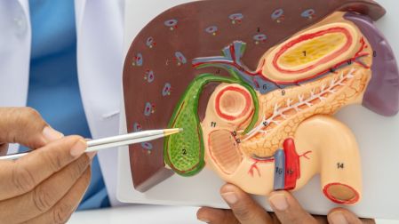 Piedras en la vesícula: síntomas confundimos con colitis