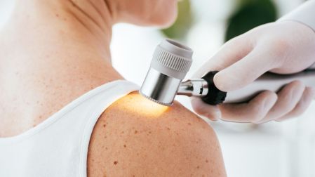 ¿Hay vacuna contra el cáncer de piel Esto sabemos del desarrollo de Moderna y Merck