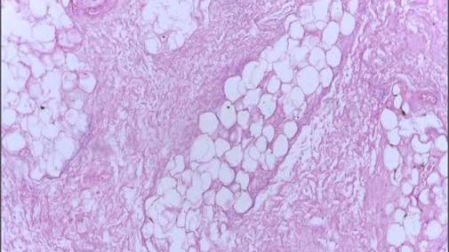Necrosis grasa