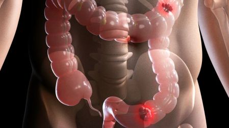 Cáncer de colon en jóvenes