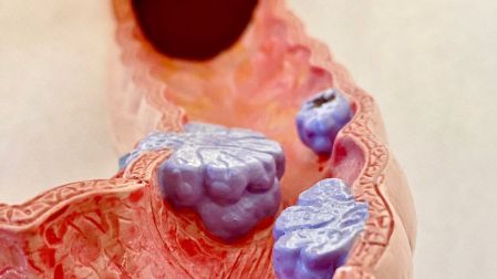 Cáncer de colon en jóvenes
