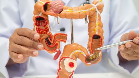 Cáncer de colon en jóvenes