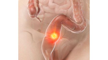 Cáncer de colon en jóvenes