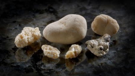 Primeros síntomas de piedras en los riñones y cómo detectarlas