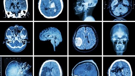 Infarto cerebral: los síntomas que debes reconocer y por qué tienes 4.5 horas para actuar