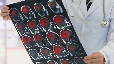 Infarto cerebral: los síntomas que debes reconocer y por qué tienes 4.5 horas para actuar