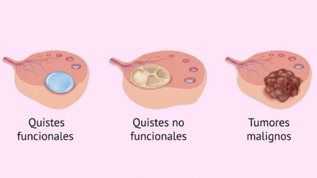 Además de los funcionales, existen otros tipos, como los quistes dermoides, los cistoadenomas y los endometriomas.