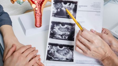 El SOP afecta aproximadamente a 10% a 13% de las mujeres en edad reproductiva