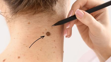 Las manchas y verrugas son algunas de las señales de alerta para visitar a un dermatólogo.