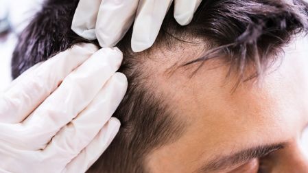 La caída de cabello también se atiende con un dermatólogo.