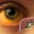 Cuáles son los tipos de hepatitis síntomas y diferencias radio
