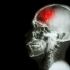Infarto cerebral: los síntomas que debes reconocer y por qué tienes 4.5 horas para actuar