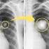 Los nódulos pulmonares podrían ser indicador de cáncer