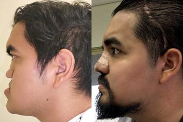 Ángel Abraham recuperó la respiración, masticación y su calidad de vida mediante una reconstrucción facial integral realizada por especialistas del Seguro Social en Nuevo León.