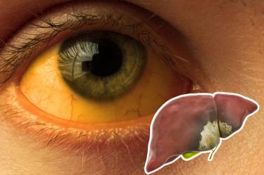 Cuáles son los tipos de hepatitis síntomas y diferencias radio