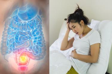 Cáncer de colon en jóvenes