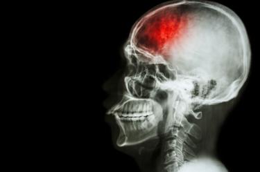 Infarto cerebral: los síntomas que debes reconocer y por qué tienes 4.5 horas para actuar