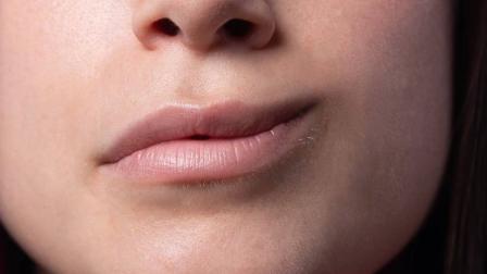 Pasos para identificar parálisis facial