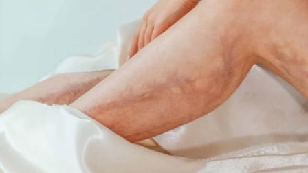 ¿La trombosis es una de las principales causas de complicaciones vasculares prevenibles?