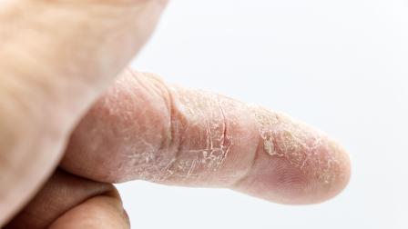 Día Mundial de la Psoriasis: enfermedad inflamatoria de la piel que afecta al 2% del mundo